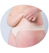 Abdominoplastia