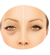 Blefaroplastia