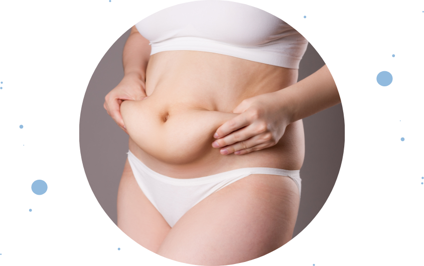 Miniabdominoplastia