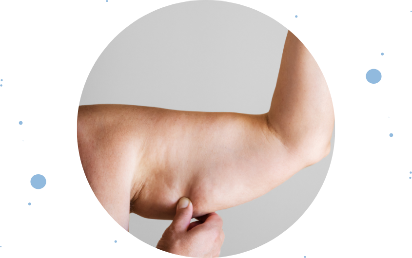 Lipodebrazo